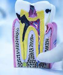 شیرین گلیکانلوی میلان -Shirin Glikanlouye Milan-Dental Filling- پرکردن دندان